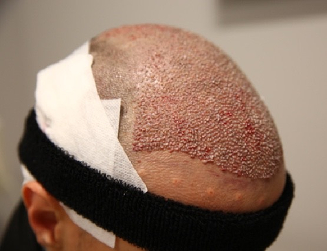 Slider image (5) Biruni Hair Institute